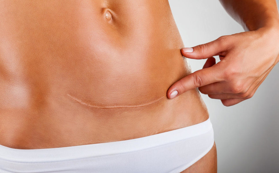 The Sagging Belly After a Hysterectomy: Causes, Consequences, and Solutions