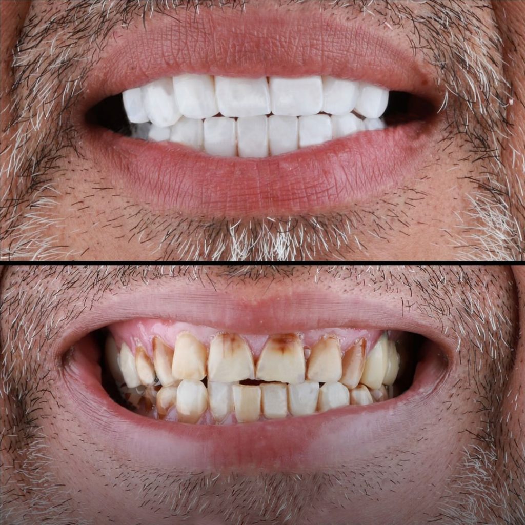 The Ultimate Comparison of Hollywood Smile Procedures: Coventry vs İzmir