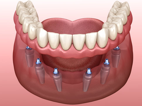 Comprehensive Comparison of All-On-6 Dental Implants: Belfast vs. Elazığ