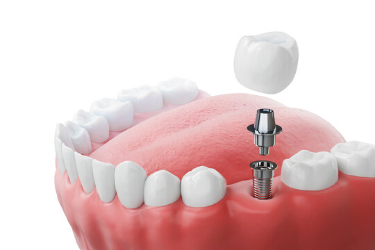 The Definitive Guide to Comparing Dental Implant Costs: Dubai vs. Istanbul