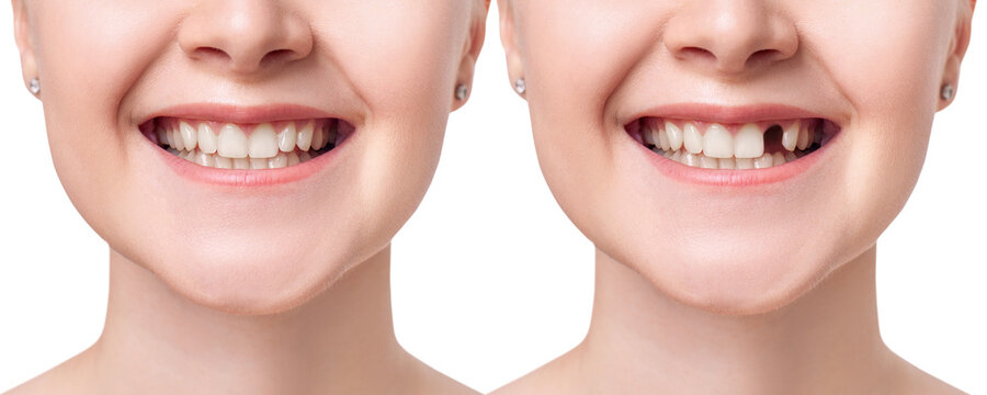 Dental Implants: A Comprehensive Comparison of Procedures in Leicester vs. Istanbul