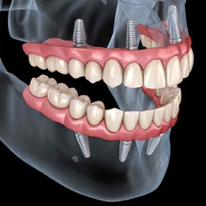 All-on-6 Dental Implants Cost in Turkey.
