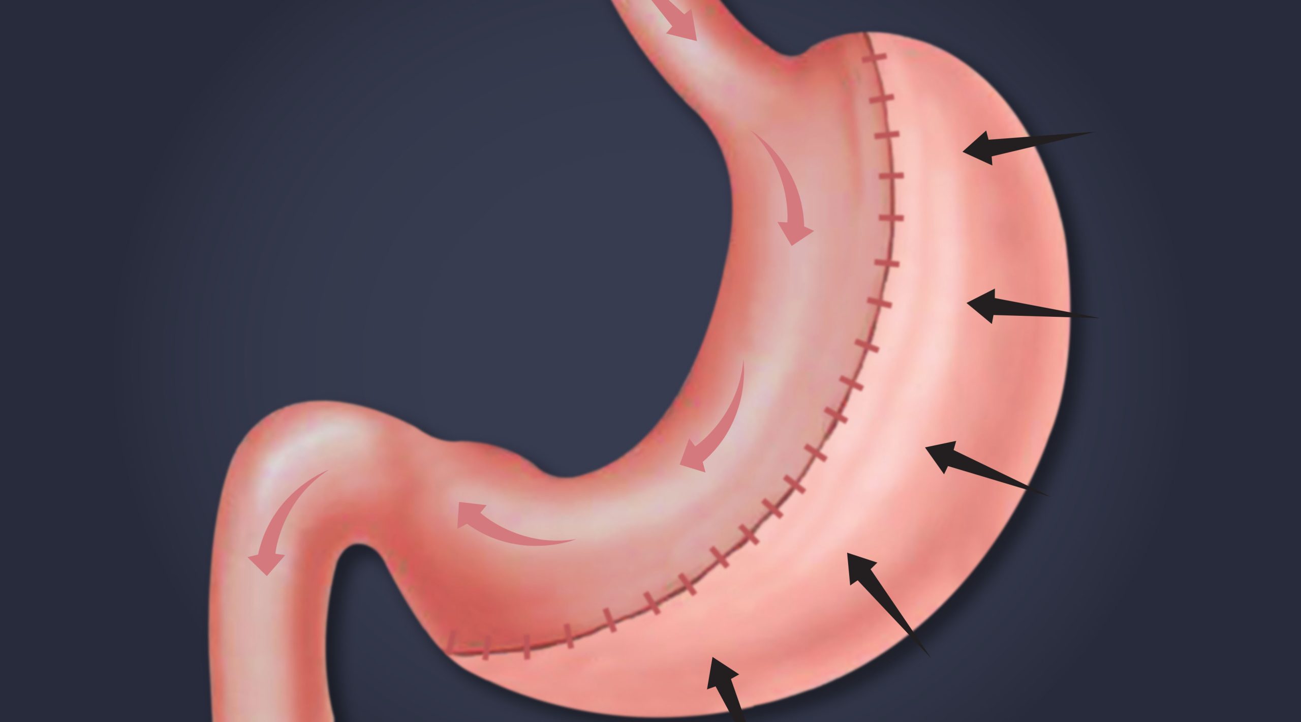 Comprehensive Guide to Gastric Sleeve Revision Prices in Turkey
