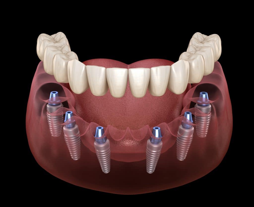 Comprehensive Comparison of All-On-6 Dental Implant Costs: United Arab Emirates vs. Turkey