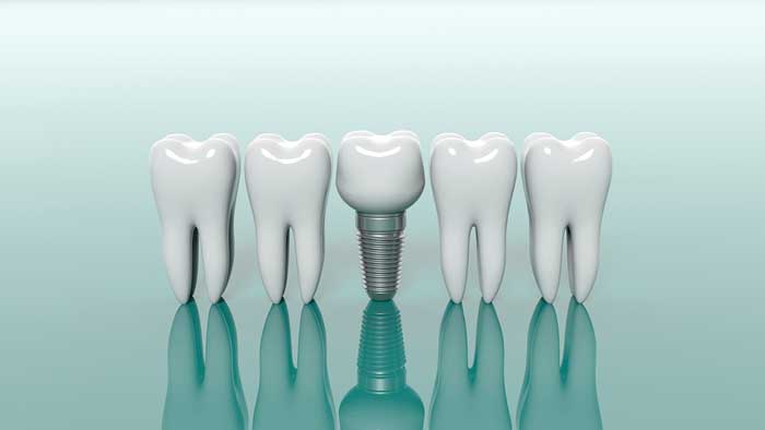 In-Depth Exploration of Dental Implant Costs in Turkey: Comprehensive Guide, Factors, and Considerations