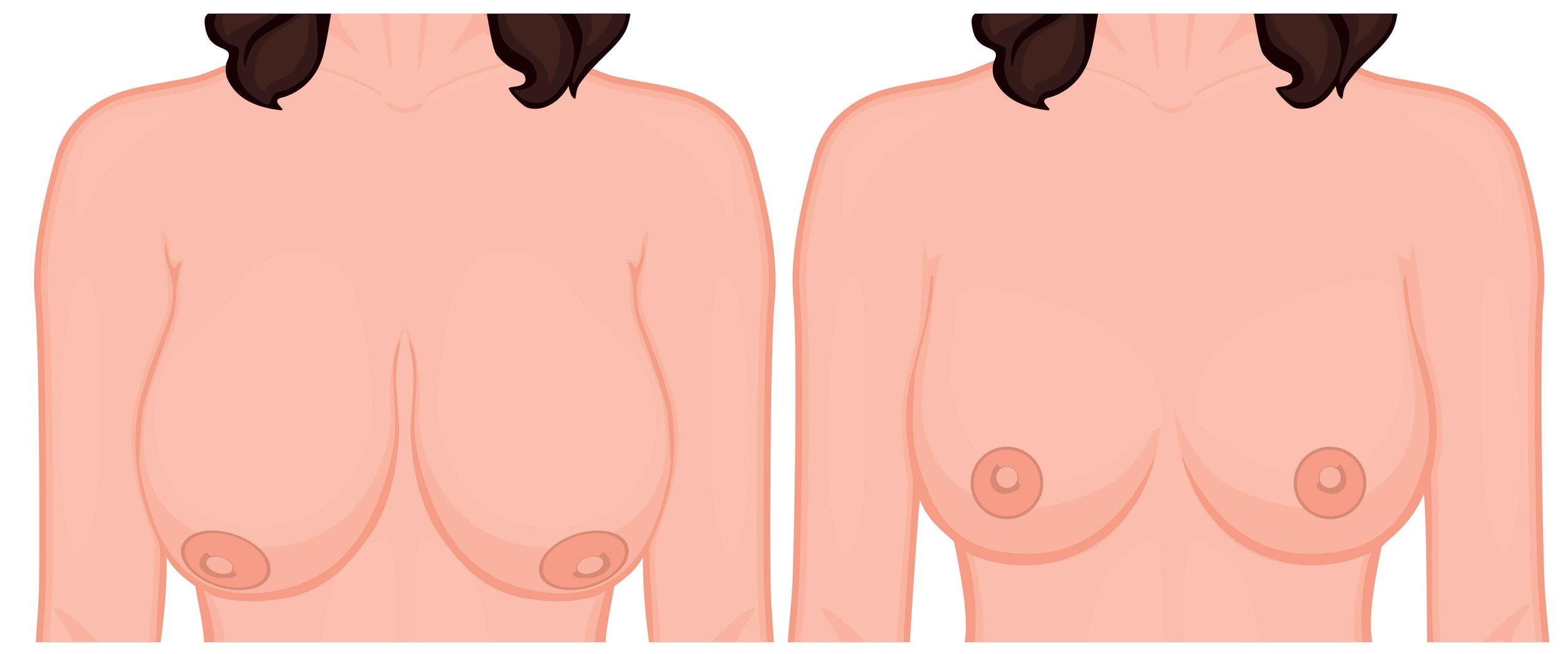 In-Depth Comparison of Breast Reduction Procedures: Westminster vs Ankara Deciding to undergo
