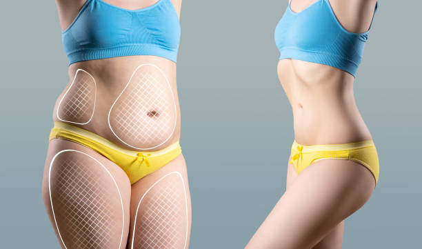Comprehensive Comparison of Liposuction Procedures: Bradford vs Ankara