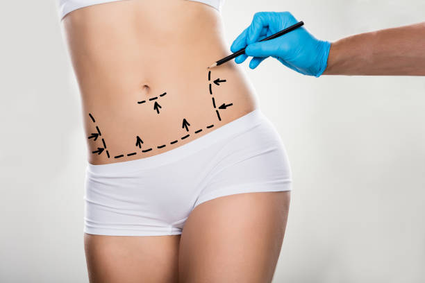 Tummy Tuck Procedure Prices in Turkey: Costs, Factors, and Considerations