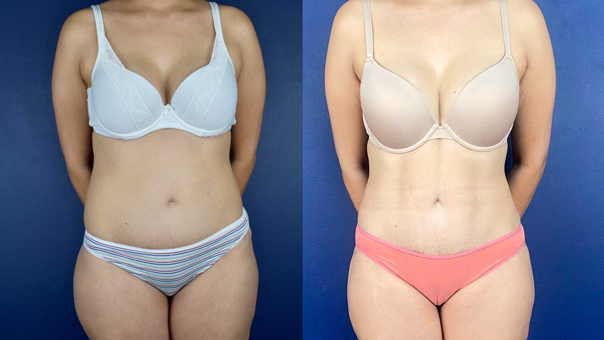 The Ultimate Guide to Liposuction Prices in Turkey, Comprehensive Cost Breakdown, Factors, and Considerations