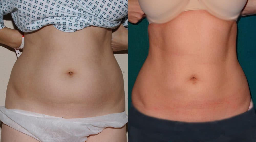Comprehensive Comparison of Liposuction Costs in Glasgow vs. Elazığ: Everything You Need to Know