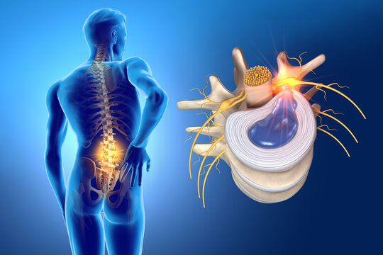 Comprehensive Guide to Herniated Disc Surgery Prices in Turkey: Everything You Need to Know