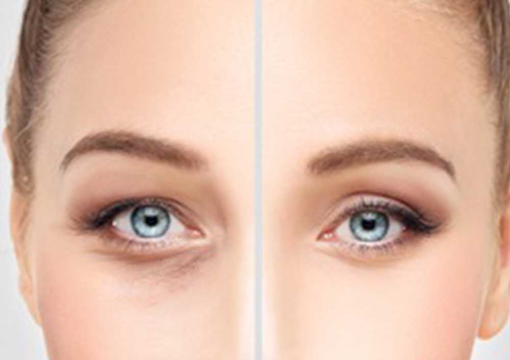 Comprehensive Guide to Cosmetic Surgery for Under Eye Fat Removal in Turkey: Prices, Factors, and Considerations