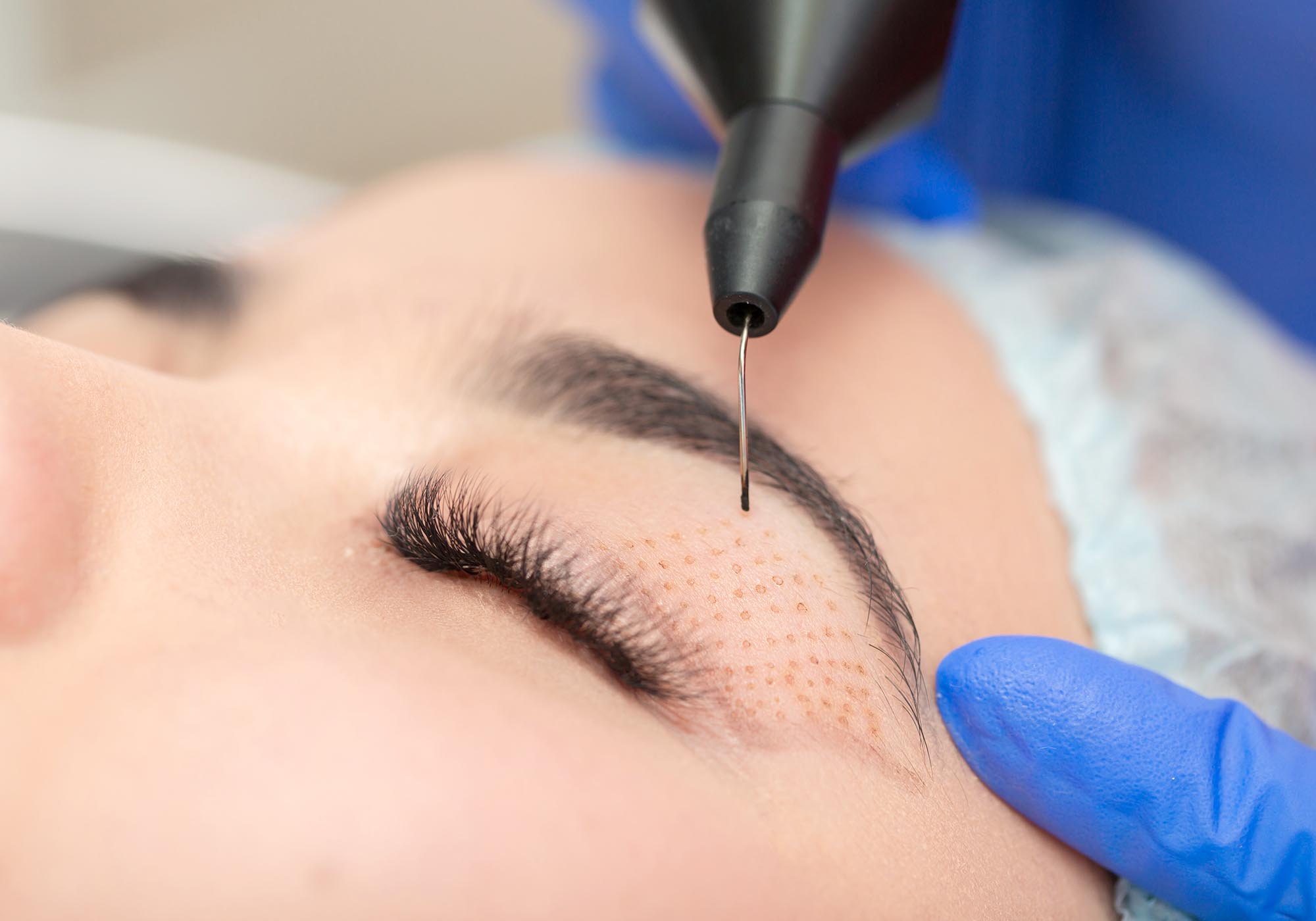 Comprehensive Guide to the Cost of Laser Eyelid Lift Without Surgery in Turkey