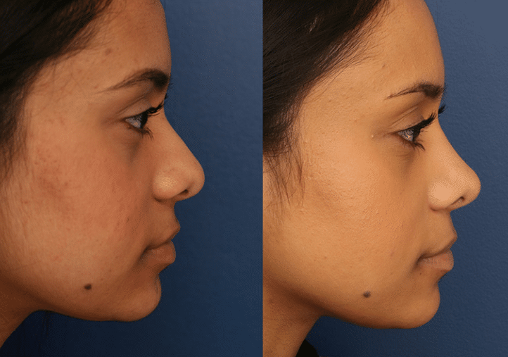 In-Depth Exploration of the Cost of Ethnic Nose Job in Turkey