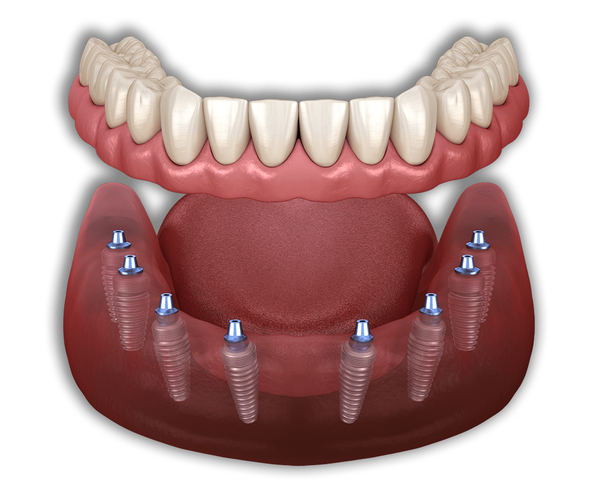 Comprehensive Guide to All on 8 Dental Implant Prices in Turkey: Everything You Need to Know