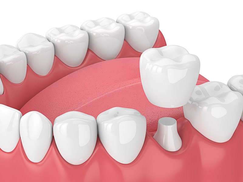 Comprehensive Guide to Dental Crown Prices in Turkey