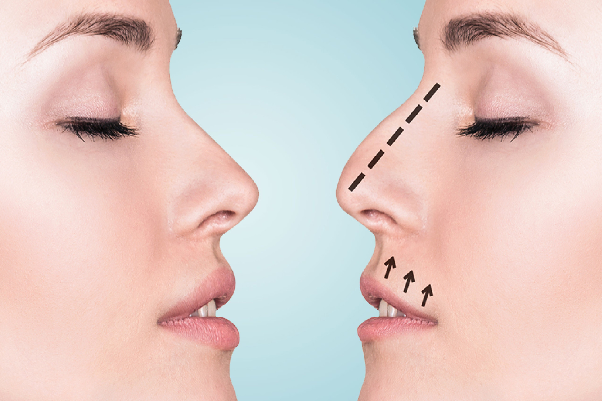 Ultimate Guide to the Cost of Correcting a Stuffy Nose with Functional Rhinoplasty in Turkey