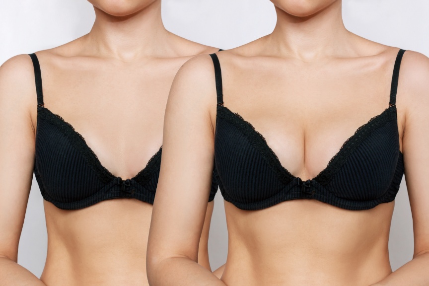 Ultimate Guide to the Cost of Breast Augmentation Surgery in Turkey