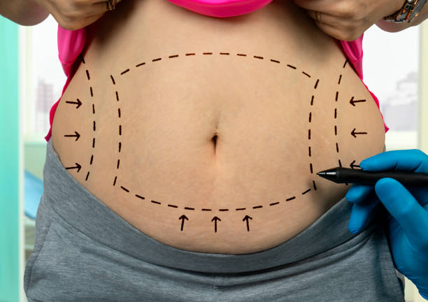 Comprehensive Guide to the Cost of Cosmetic Surgery for a Flat Stomach in Turkey