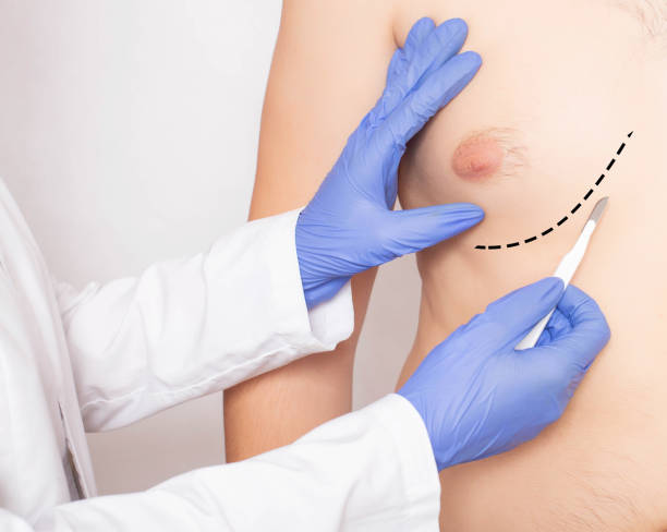 Corrective Breast Surgery for Gynecomastia in Turkey: A Comprehensive Guide