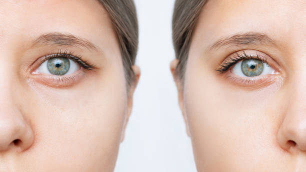 Comprehensive Guide to Blepharoplasty Prices in Turkey