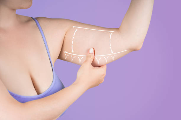 Comprehensive Guide to the Cost of Cosmetic Surgery to Remove Underarm Rolls in Turkey