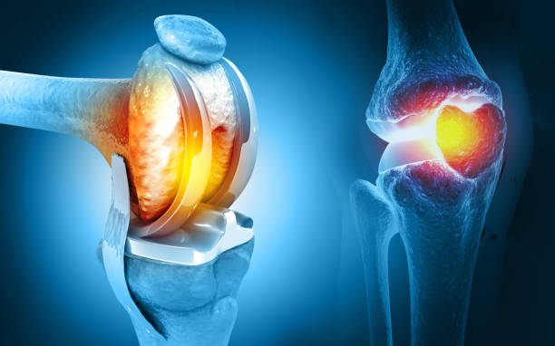 Comprehensive Guide to Knee Prosthesis Installation Prices in Turkey