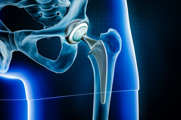 The Comprehensive Guide to the Price of Intermediate Hip Prosthesis Procedure in Turkey