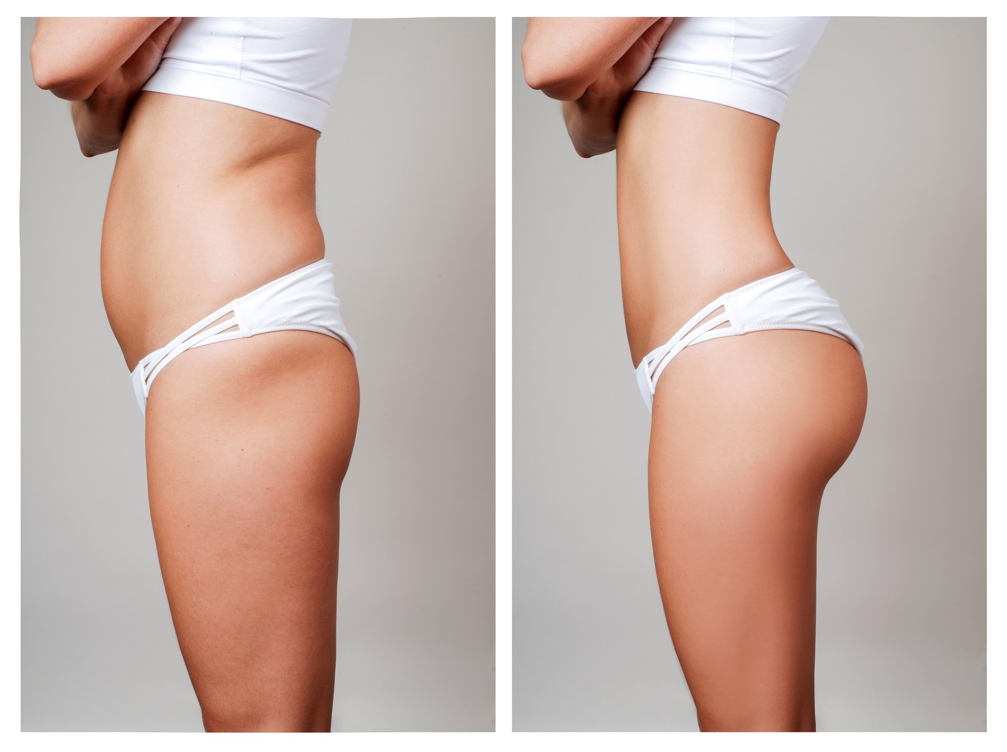 Complete Guide to Butt Fat Removal Costs in Turkey: Prices, Procedures, and Considerations