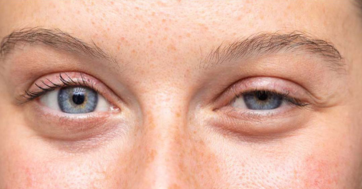 Affordable Drooping Eyelids Surgery in Turkey: An In-depth Pricing Guide