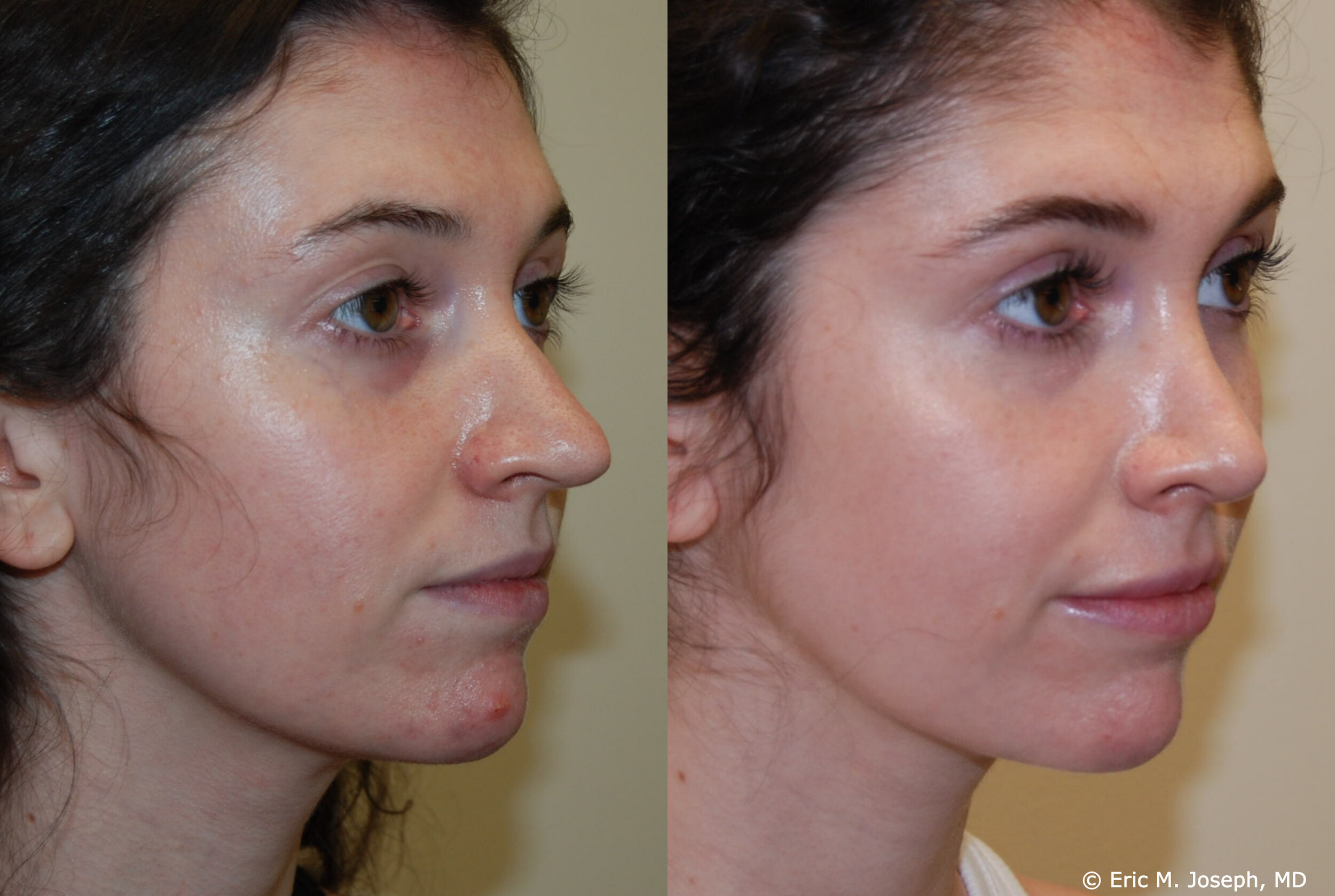 Comprehensive Guide to Secondary Rhinoplasty Prices in Turkey: Everything You Need to Know