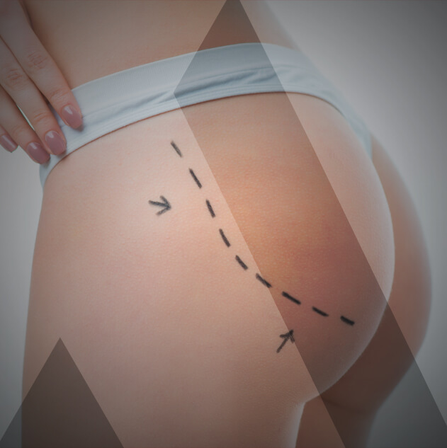 buttock-augmentation-turkey